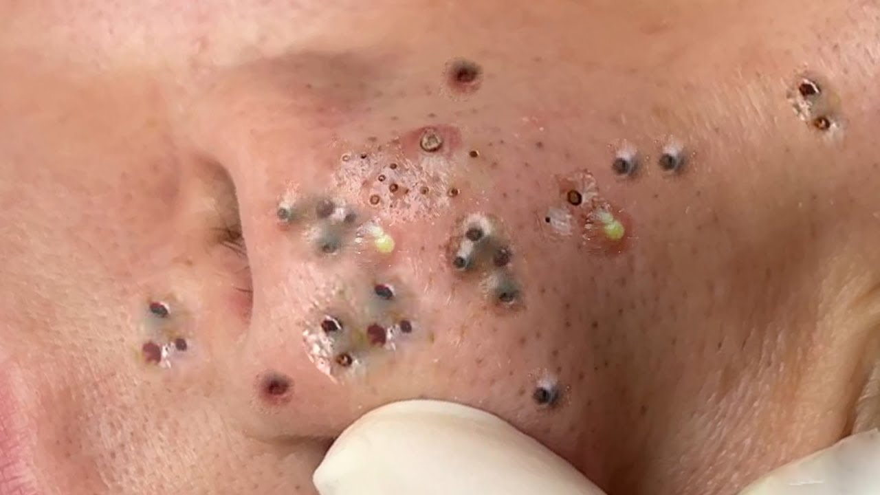 Blackhead Removal 2